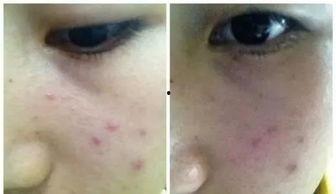 明星网红痘痘贴,揭秘祛痘神器背后的护肤秘密