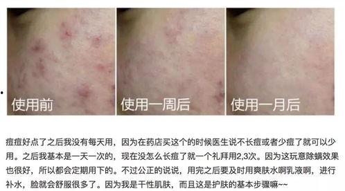 明星网红痘痘贴,揭秘祛痘神器背后的护肤秘密