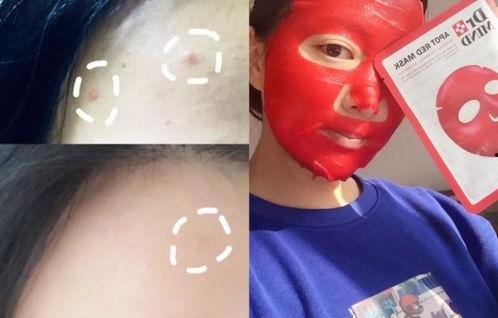 明星网红痘痘贴,揭秘祛痘神器背后的护肤秘密